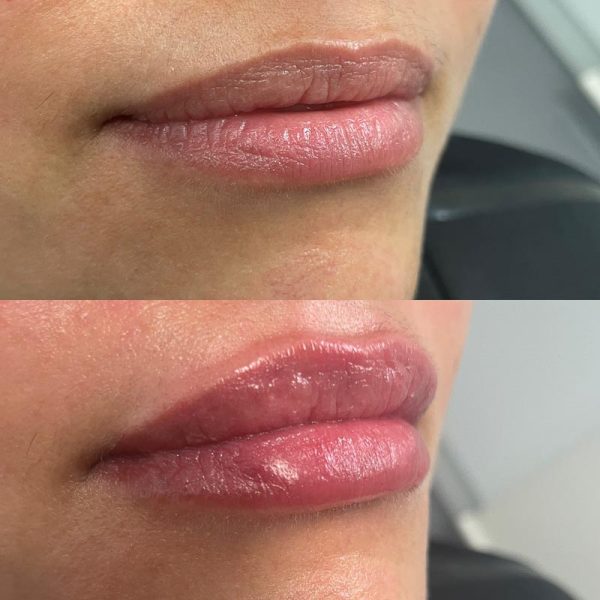 Lip Fillers Botox Wellington Wellington Cosmetic Clinic