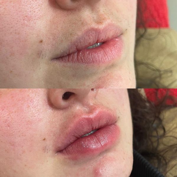 Lip Fillers Botox Wellington Wellington Cosmetic Clinic
