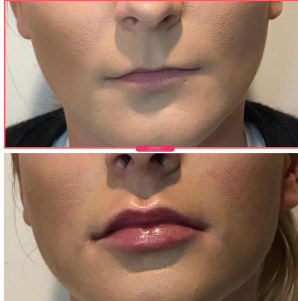 Lip Fillers Botox Wellington Wellington Cosmetic Clinic