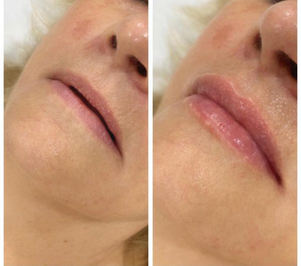 Lip & Cheek Augmentation Botox Wellington Wellington Cosmetic Clinic