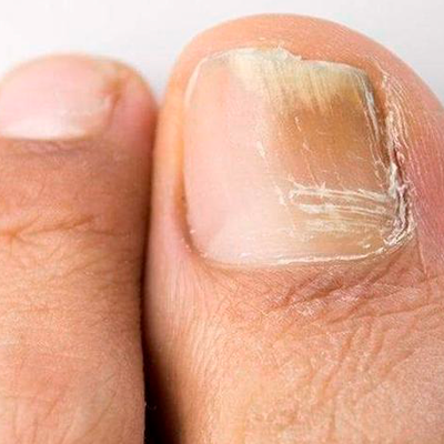 Fungal Nail Infection Treatment at Glowry Cosmetic